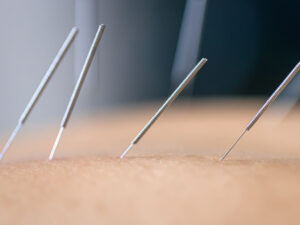 serveis en tractaments de acupuntura